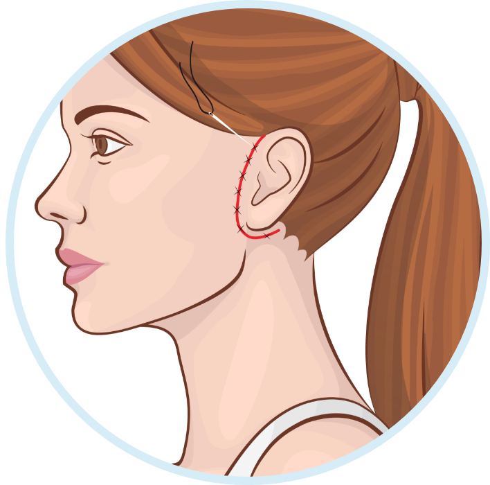 Подизање обрва (brow lift) Турска