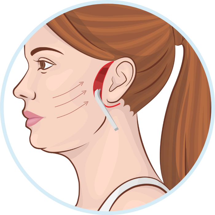 Подизање обрва (brow lift) Турска