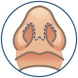 Reviziona rinoplastika u Turskoj