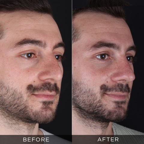 muška-rinoplastika-pre-i-posle-10