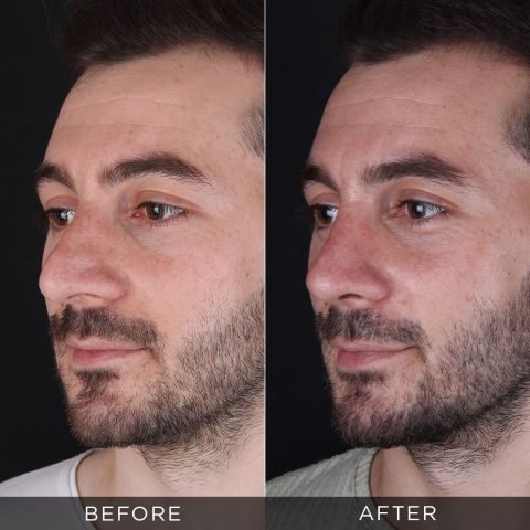 muška-rinoplastika-pre-i-posle-11