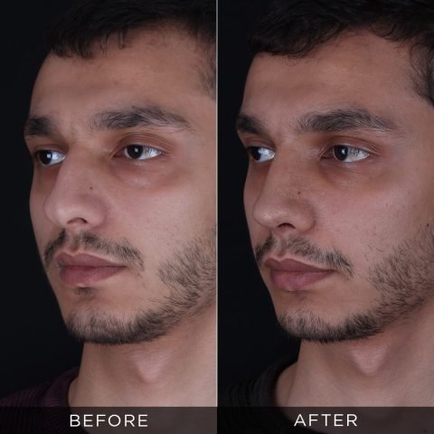 muška-rinoplastika-pre-i-posle-12