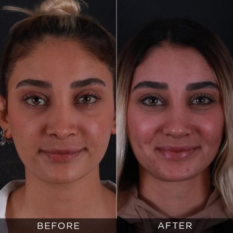 reviziona-rinoplastika-pre-posle-3