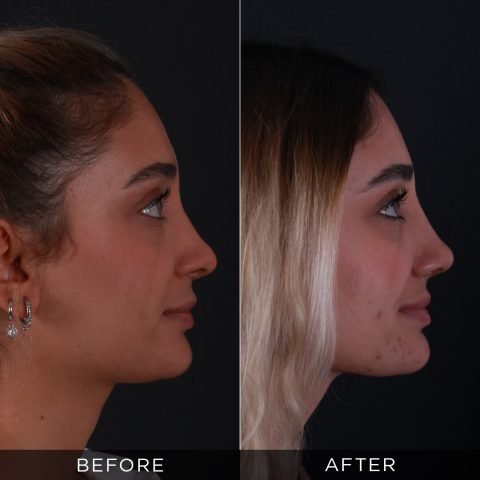 reviziona-rinoplastika-pre-posle-4