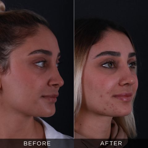 reviziona-rinoplastika-pre-posle-5