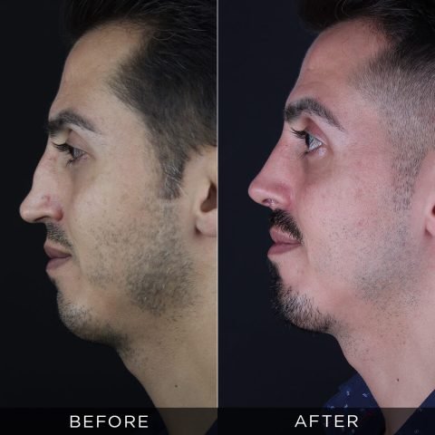 reviziona-rinoplastika-pre-i-posle-11