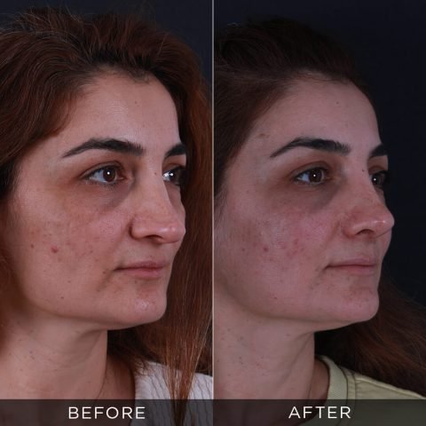 reviziona-rinoplastika-pre-i-posle-3