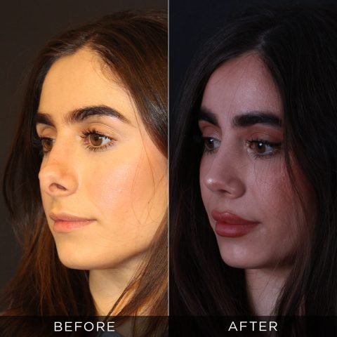 reviziona-rinoplastika-pre-i-posle-4