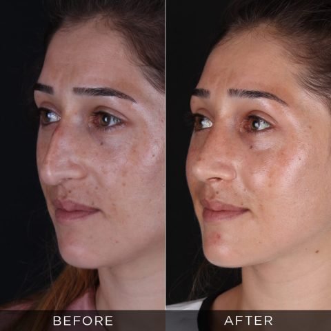 rinoplastika-pre-i-posle-79