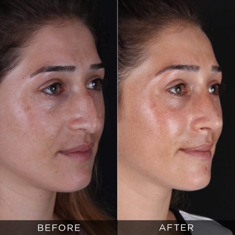 rinoplastika-pre-i-posle-80