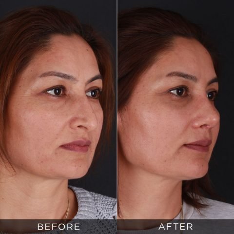 Rinoplastika 1 mesec posle operacije