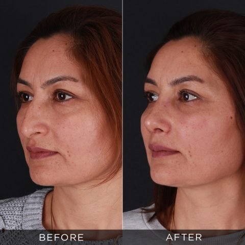 1 mesec posle operacije nosa