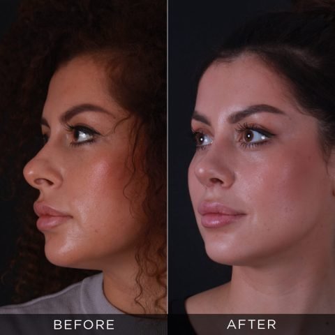 Operacija nosa 6 meseci posle