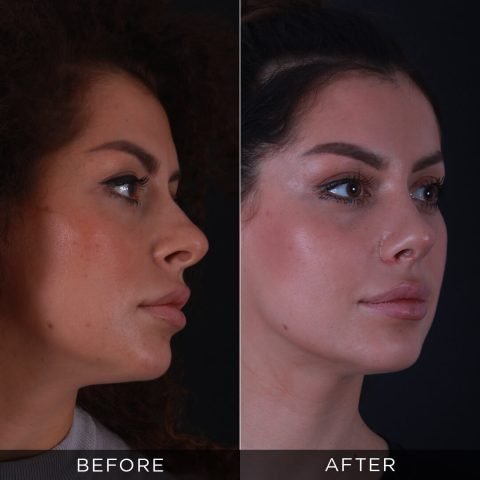 6 meseci posle operacije nosa