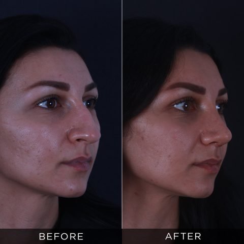 rinoplastika-pre-i-posle-87