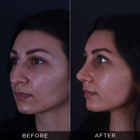 rinoplastika-pre-i-posle-88