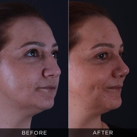 rinoplastika-pre-i-posle-91