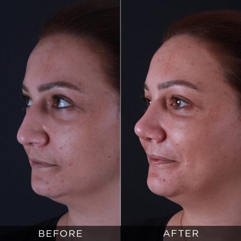 rinoplastika-pre-i-posle-92