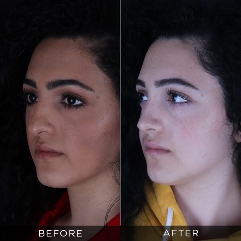 rinoplastika-pre-i-posle-93