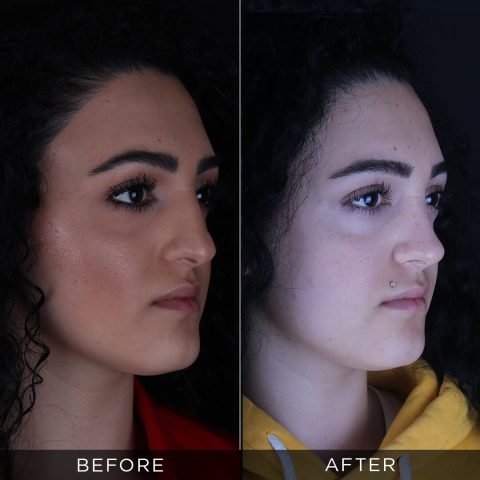 rinoplastika-pre-i-posle-94