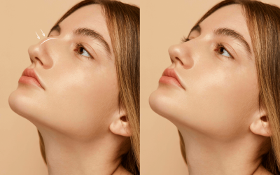 Rinoplastika debele kože