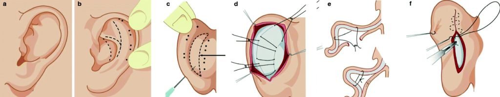 kakav-je-proces-ozdravljenja-posle-otoplastike-hirurgije