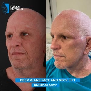 duboko-ravno-podizanje-lica-u-turskoj-fotografije