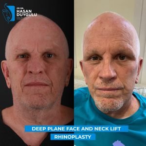 duboko-ravno-podizanje-lica-fotografije-istanbul