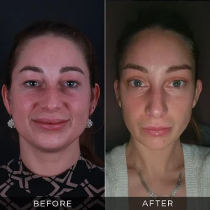 Fotografije pre i posle operacije lisičjih očiju u Turskoj