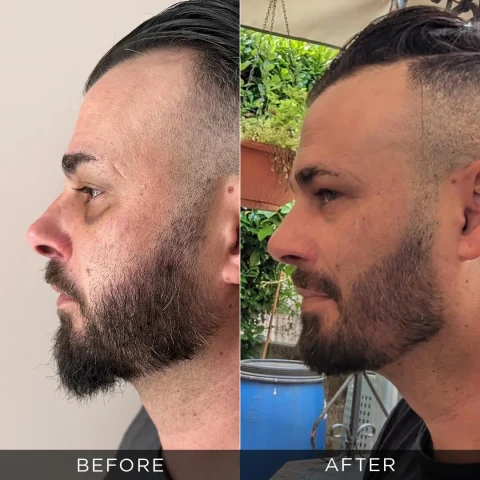 muška-reviziona-rinoplastika-pre-posle-optimizovano