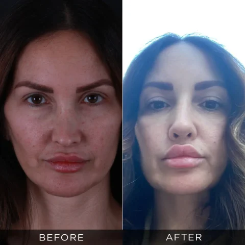 reviziona-rinoplastika-pre-posle-20-optimizovano