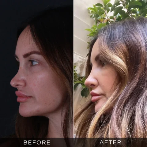 reviziona-rinoplastika-pre-posle-22-optimizovano