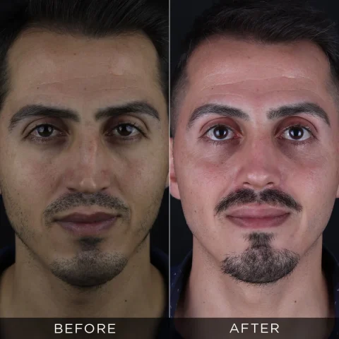 reviziona-rinoplastika-pre-i-posle-12-optimizovano