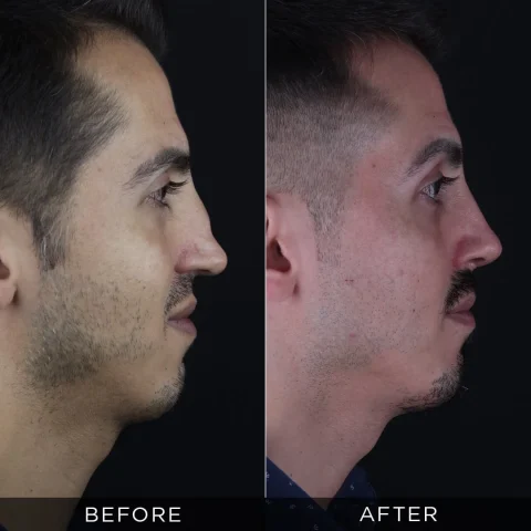 reviziona-rinoplastika-pre-i-posle-13-optimizovano