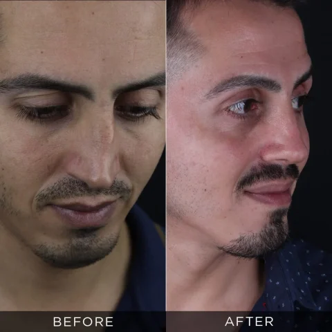 reviziona-rinoplastika-pre-i-posle-14-optimizovano