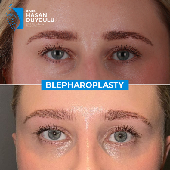 blepharoplasty-turkey-with-dr-hasan-duygulu