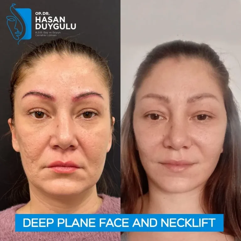 deep-plane-face-lift-in-turkey