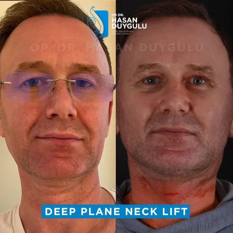deep-plane-face-lift-turkey