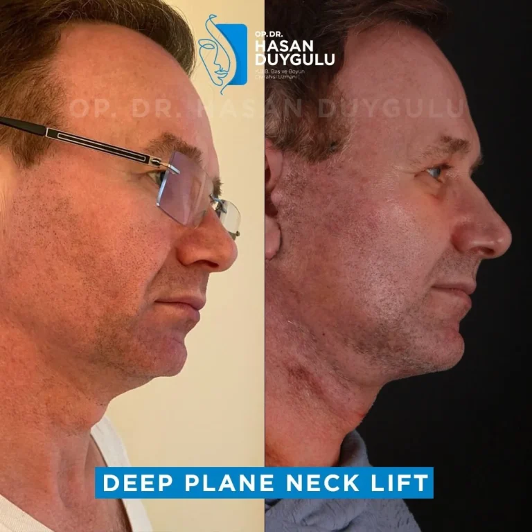 deep-plane-neck-lift