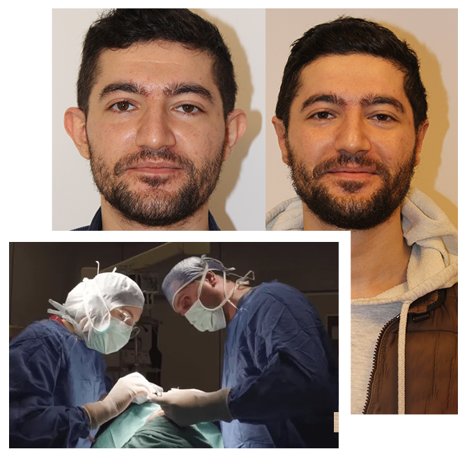 Otoplastika u Turskoj (estetika ušiju)