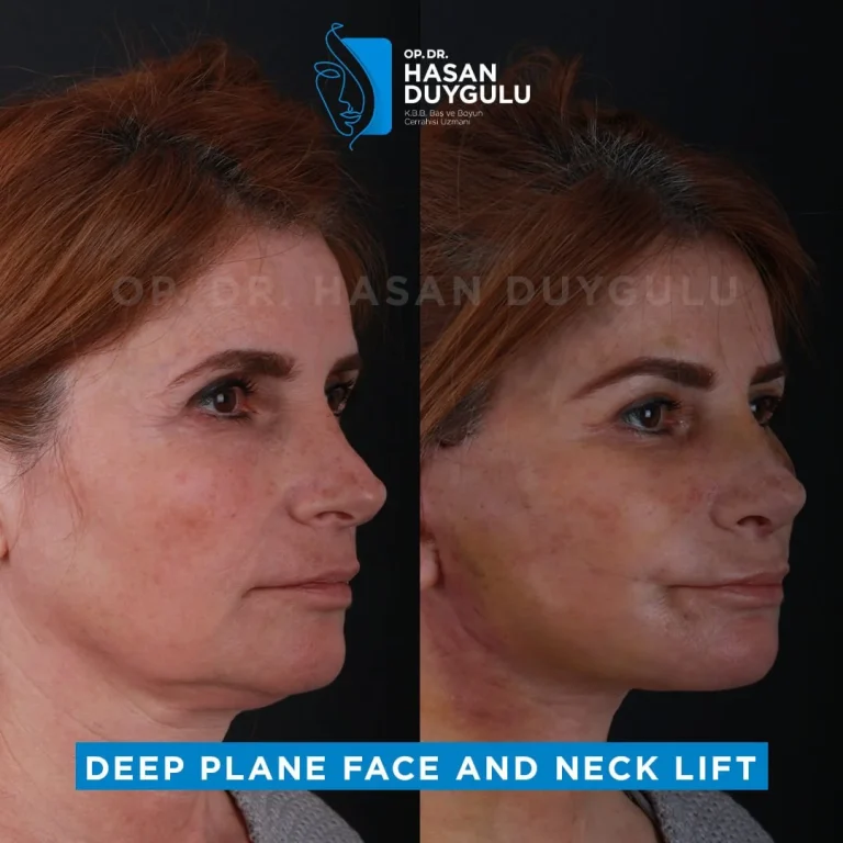 face-lift-before-after-1-1