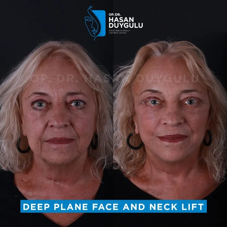 face-lift-before-after