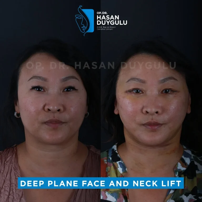face-lift-before-after