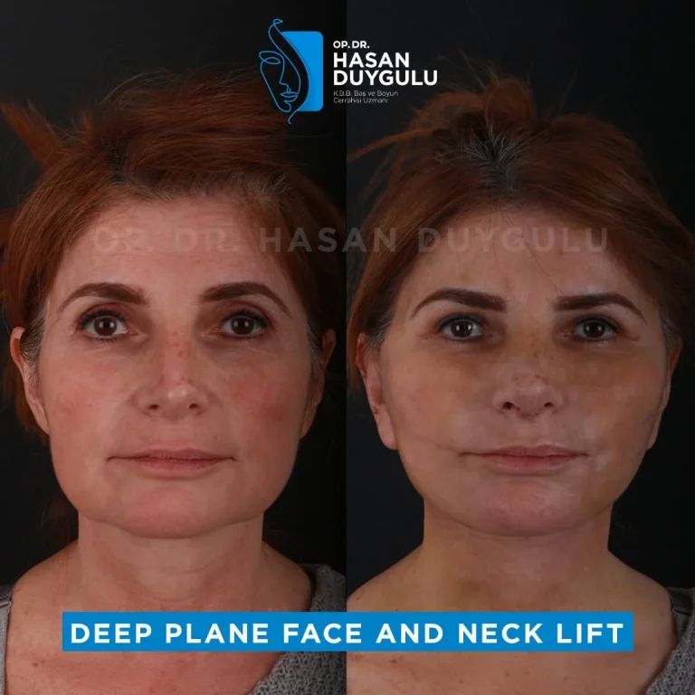 face-lift-before-after-turkey-1