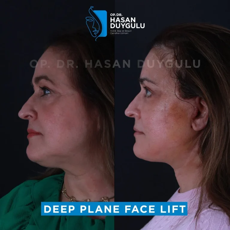 face-lift-before-after-turkey