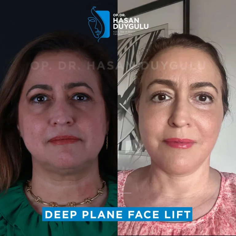 face-lift-before-and-after