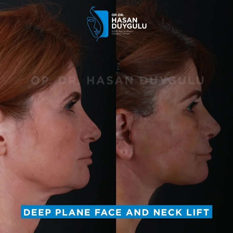 face-lift-before-and-after-in-turkey
