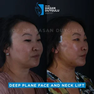 Galerija podizanja vrata u Turskoj i fotografije pre i posle