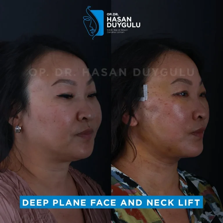 face-lift-before-and-after-istanbul
