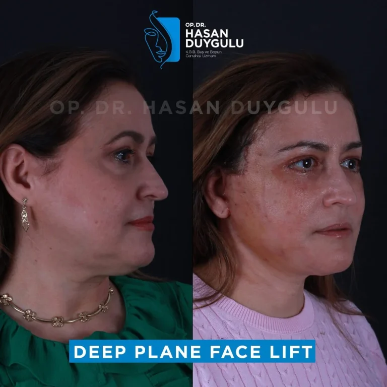 face-lift-before-and-after-turkey